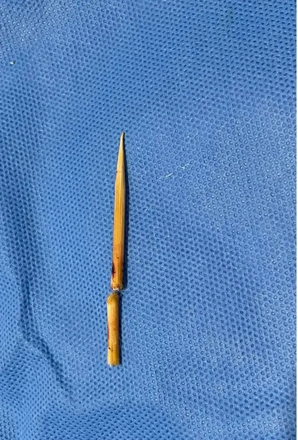 直接贯通刺伤孩子面部的竹签。医院供图