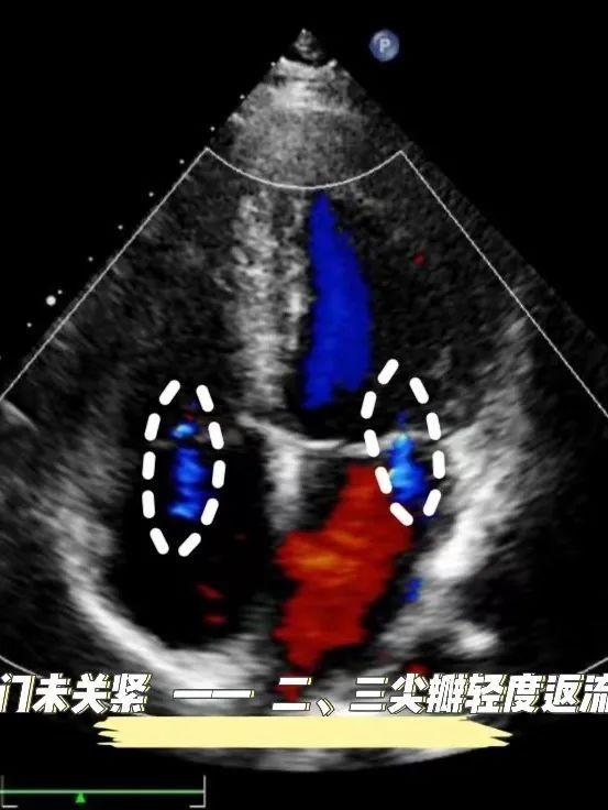 二、三尖瓣轻度返流