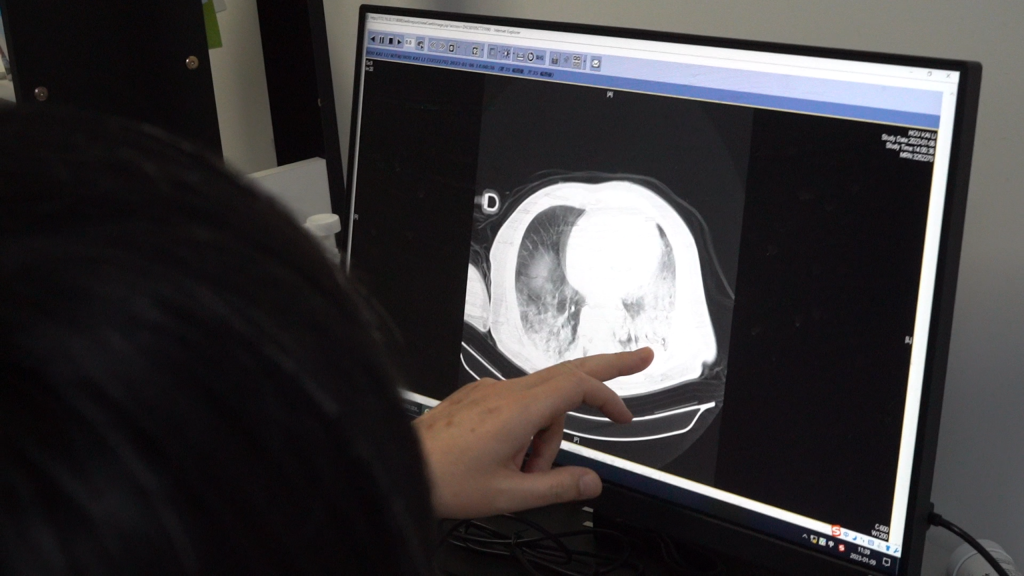 单亮在和家属讨论患者病情,老人因为新冠感染,双肺已经变成“白肺”。