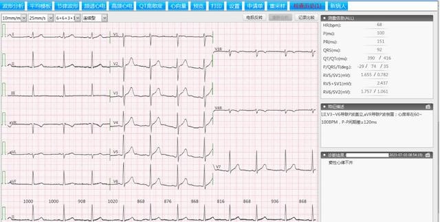 图2 窦性心律不齐