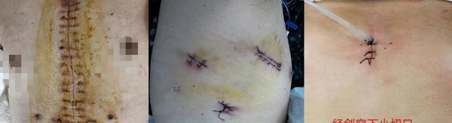 手术方式切口对比图