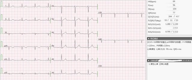 图3 正常心电图(参照)