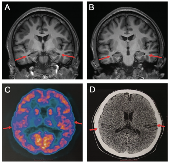 a:患者頂葉,顳葉皮質,海馬結構輕度萎縮,腦溝增大;b:雙側脈絡膜稍增寬