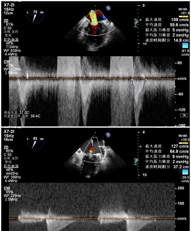 手术前后二尖瓣压差
