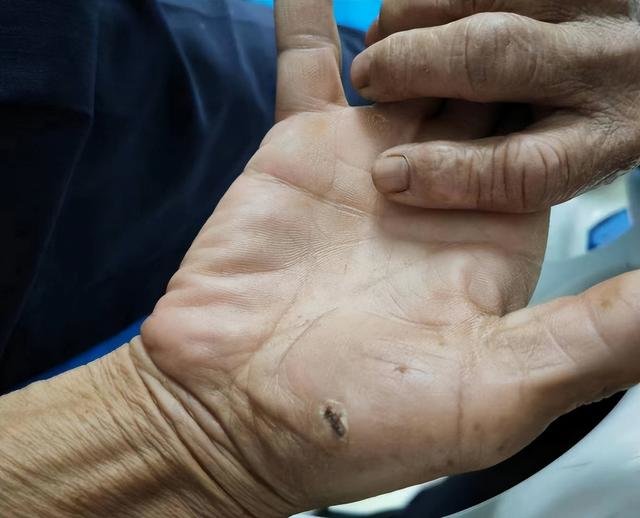 ▲李爷爷伤口情况