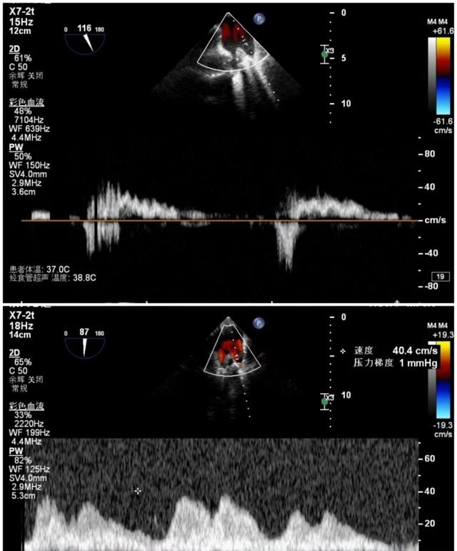 手术前后肺静脉流速