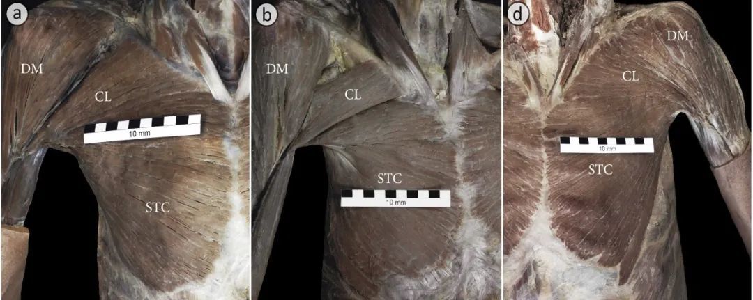 图a为典型胸大肌，仅胸肩之间有分界；图b胸大肌上、胸肩之间均有分界；图d胸肩部均无明显分界