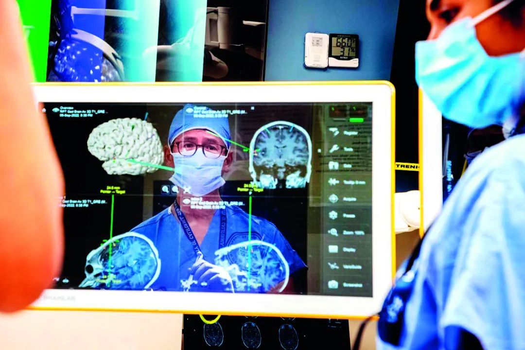 张复伦团队放置在患者大脑表面的电极片，覆盖了对语言至关重要的区域。图/加州大学