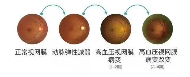 怎么看眼底相机来华德眼科给眼底照个相丨蔡司CLARUS 500真彩·高清·超广角眼底相机_https://www.jmylbn.com_新闻资讯_第3张