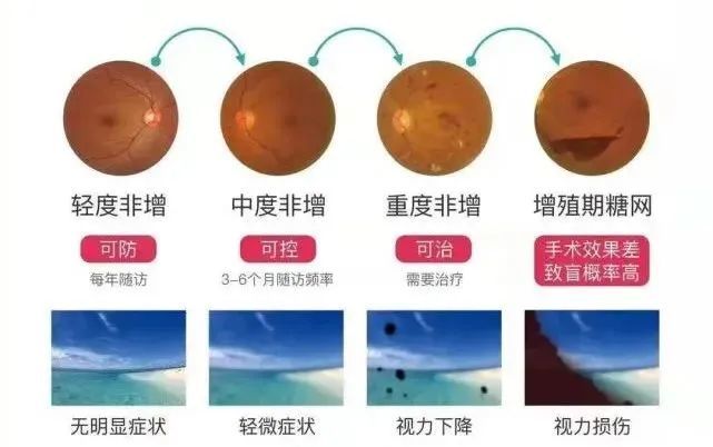 怎么看眼底相机来华德眼科给眼底照个相丨蔡司CLARUS 500真彩·高清·超广角眼底相机_https://www.jmylbn.com_新闻资讯_第4张