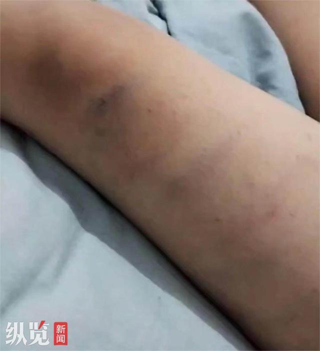 小帅胳膊和腿上有明显淤青。（来源/视频截图）