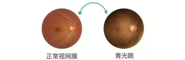 怎么看眼底相机来华德眼科给眼底照个相丨蔡司CLARUS 500真彩·高清·超广角眼底相机_https://www.jmylbn.com_新闻资讯_第6张