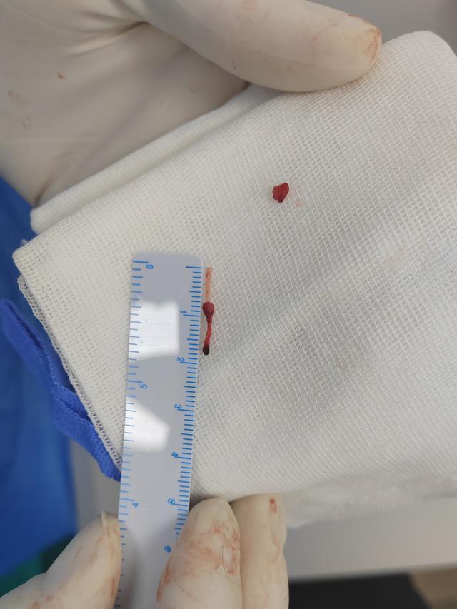 留置针头导管断在婴儿血管里随血液漂移，5年后才找到取出