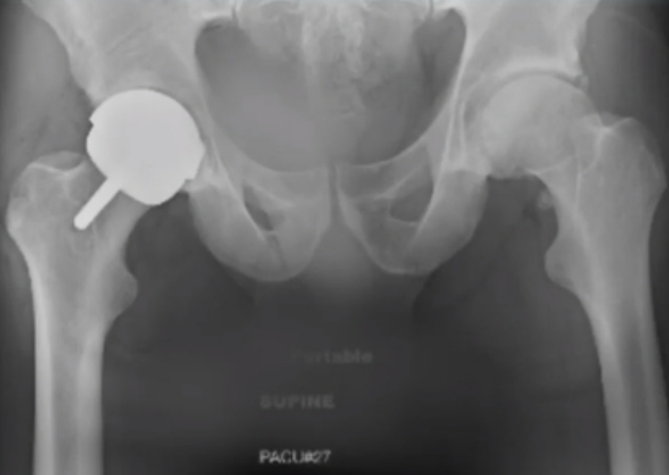穆雷的手术X光片。