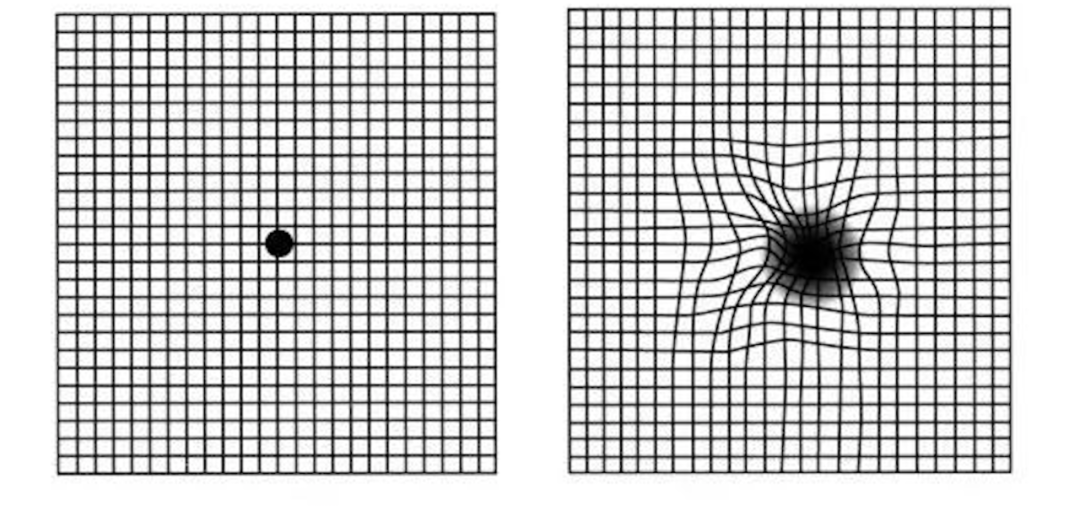 左：正常视觉；右：黄斑病变引起的异常视觉