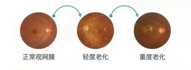 怎么看眼底相机来华德眼科给眼底照个相丨蔡司CLARUS 500真彩·高清·超广角眼底相机_https://www.jmylbn.com_新闻资讯_第5张