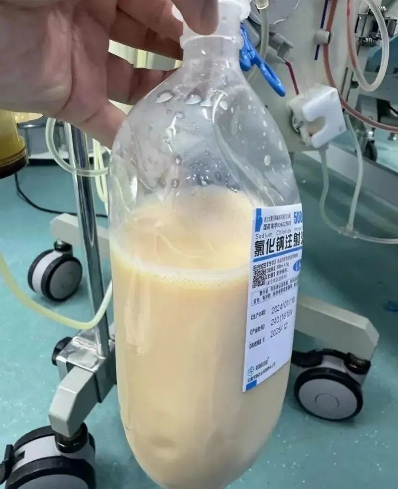 从患者体内置换出的如“牛奶”般的甘油三酯