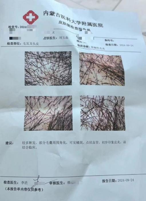 女子称离子烫后大量脱发，理发店：她在其他地方上色，出了事却找我们负责