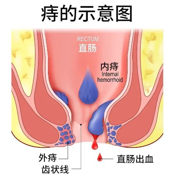 你確定這不是在玩火？“菊花”塞大蒜，可以治痔瘡？