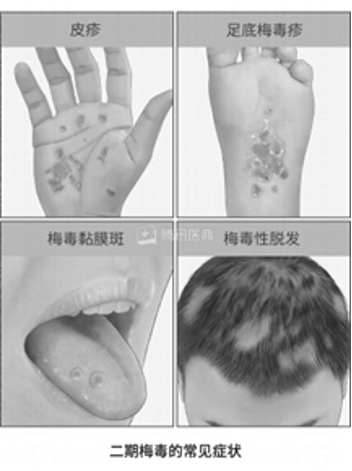 图12 博主早期疤痕照片与梅毒症状对比图 (图片来源:原博主X账号、腾讯医典)