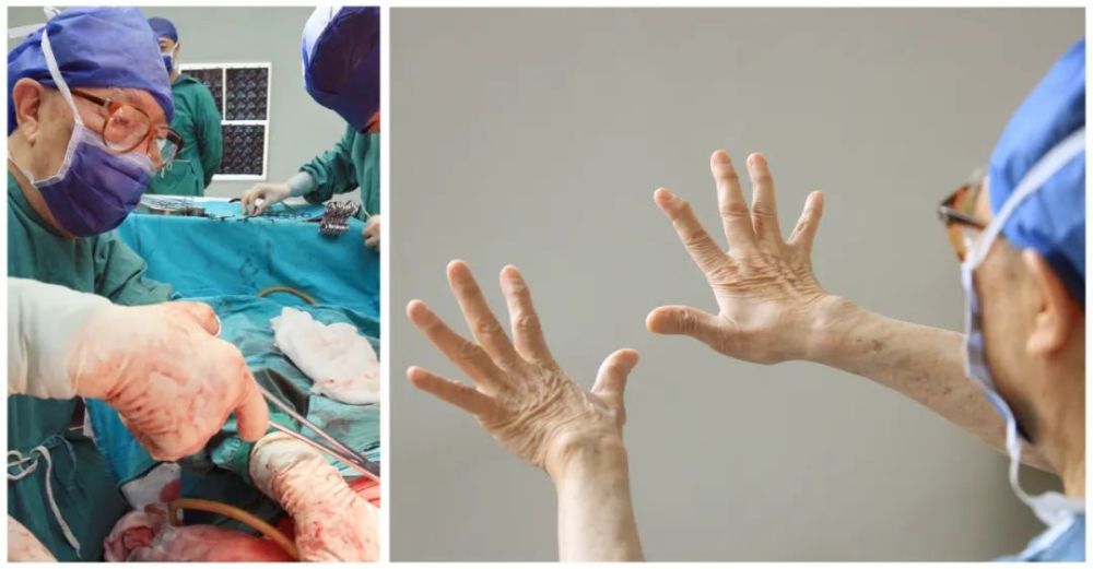 左图：吴孟超在为病人进行手术；右图：吴孟超展示他常年握止血钳的双手（拼版照片）。新华社记者 王建民 摄