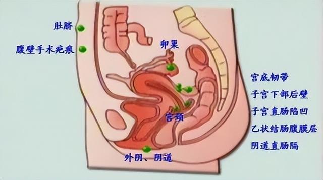 注：图示中，绿色点状标记设备异位的子宫内膜组织