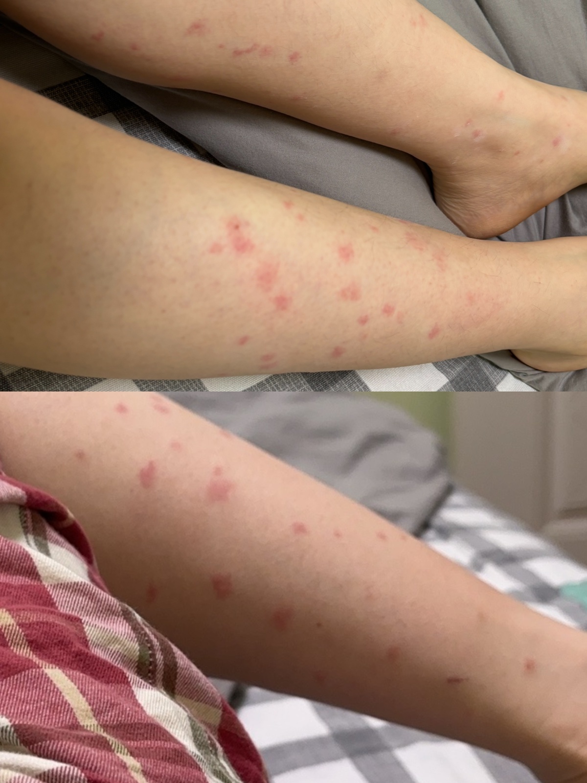 没有蚊子咬却出现“蚊子包”，医生：谨防虫咬皮炎，需及时干预, image size:1200x1600