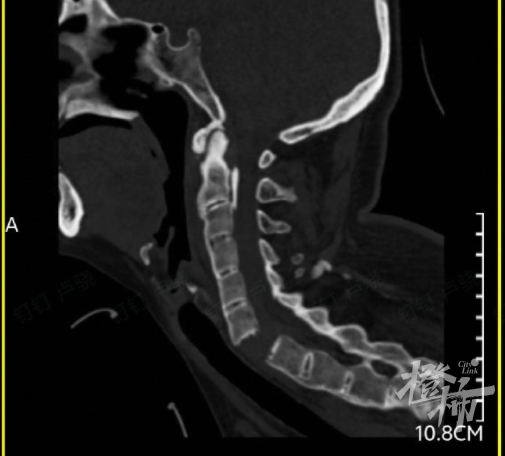 （检查发现，刘女士的颈椎完全断离）