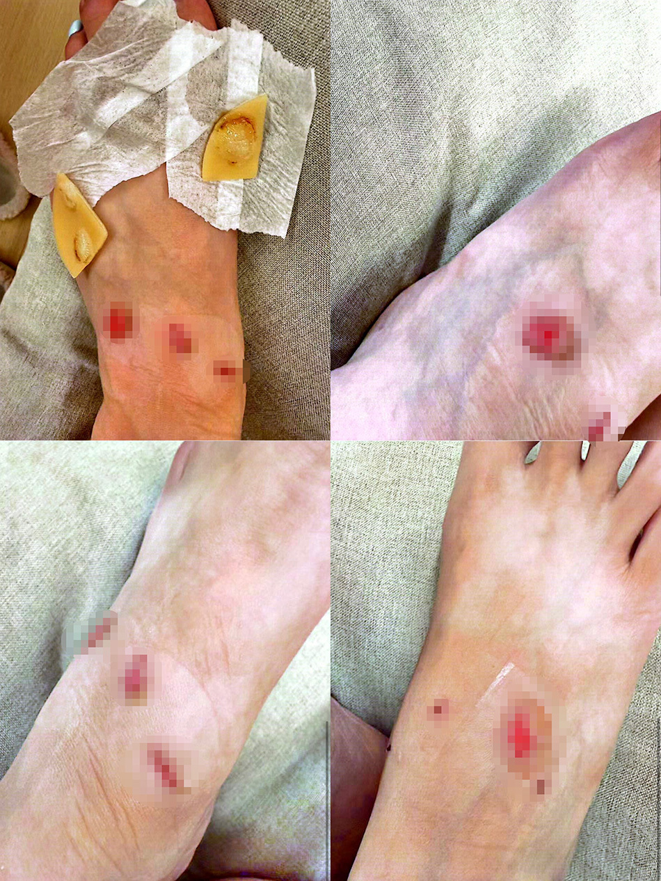 徐女士脚背部磨损图