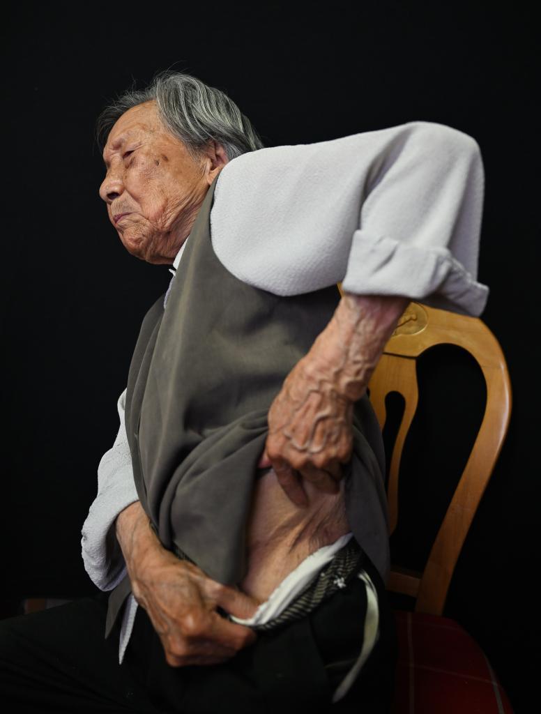 ↑2025年5月21日，夏淑琴展示自己身上的刀疤。