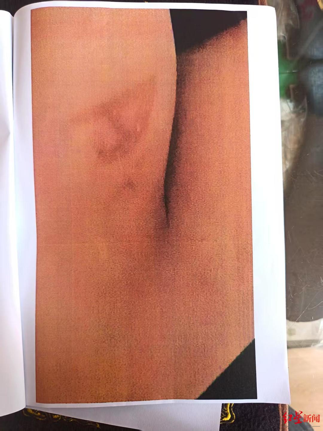 ▲小古被烫伤的伤口