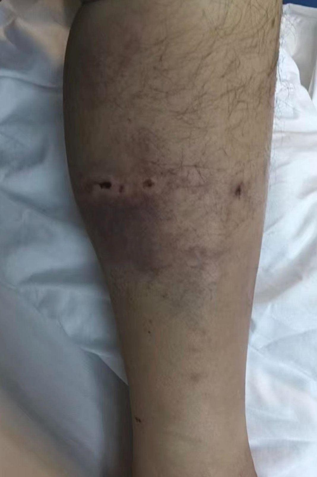 李先生小腿被熊咬傷。圖源:重慶市城口縣融媒體中心