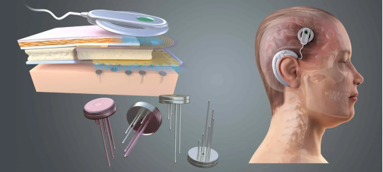 脑机接口,现在可以刷医保了