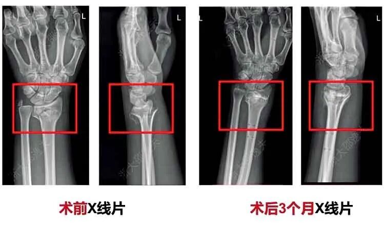 桡骨远端骨折通过“骨02”治疗病例 图片来源/浙江大学医学院附属邵逸夫医院公众号