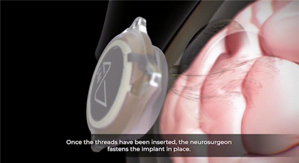 1.5秒植入！马斯克脑机接口公司技术新突破 超万人等待上脑