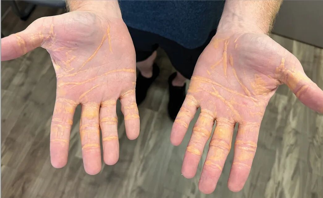 血脂高到两手发黄 | Konstantinos Marmagkiolis et al.