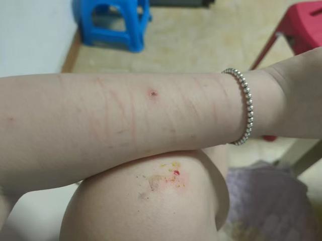 冉冉自殘留下的疤痕。圖/當(dāng)事人提供