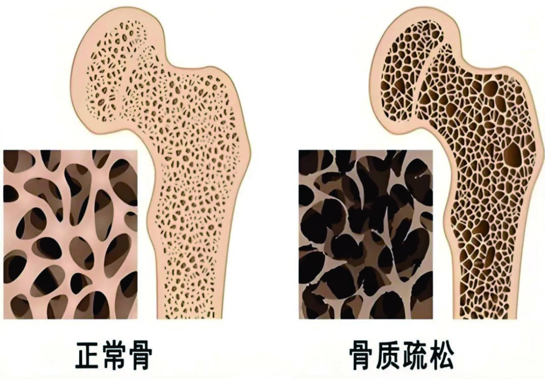 从“补了白补”到科学护骨!专家拆解骨骼的锁钙逻辑_凤凰网区域_凤凰网