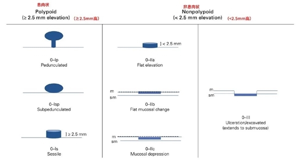 这些位置长了息肉一定要当心：有种几乎100%会癌变！