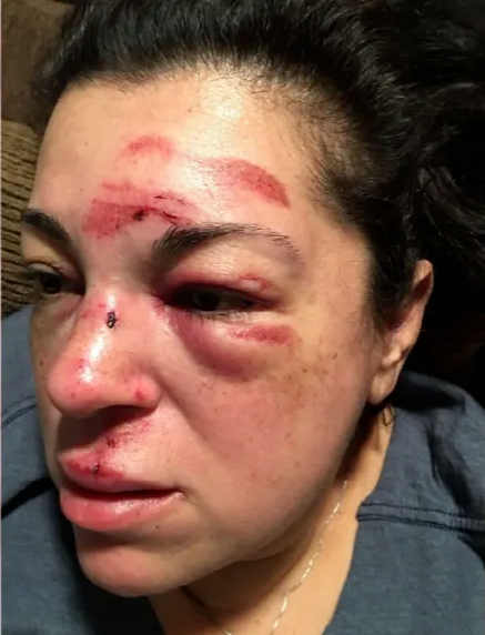 ▲古罗拉脸部受伤