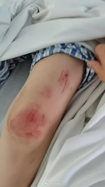 入院治療的曹依