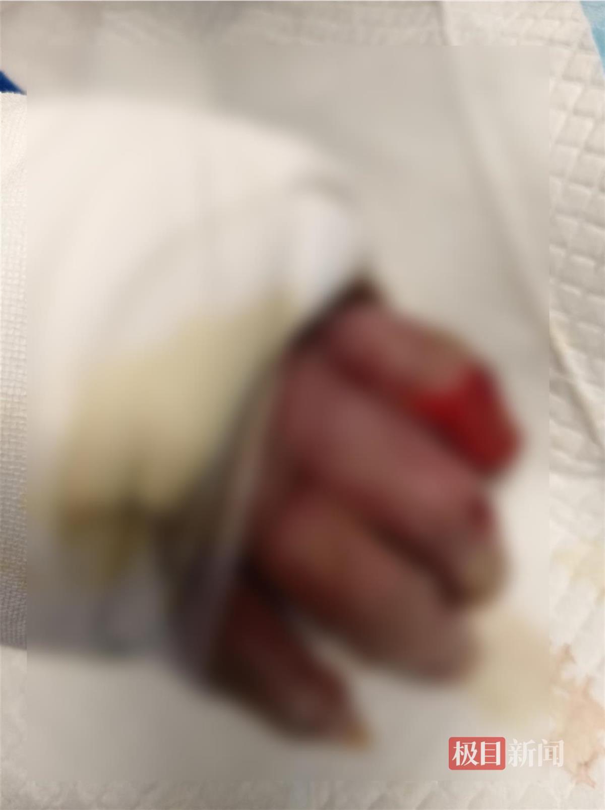 钱先生被烧伤的手部