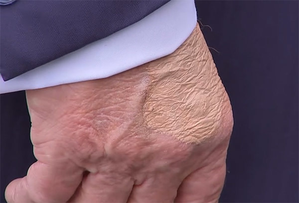 脚踝肿胀、手背淤青...白宫承认特朗普患病但“问题不大”