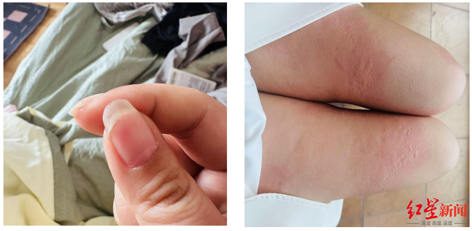 ▲刘女士指甲盖撕裂、起荨麻疹 受访者供图