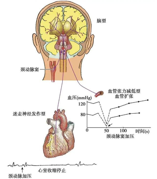 颈动脉窦综合征发生机制|图源：参考资料[3]