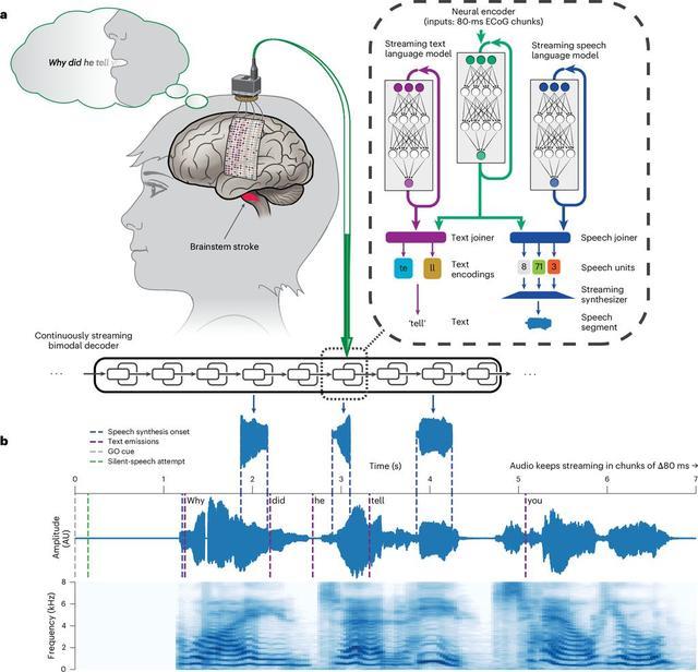 AI打破脑机接口延迟壁垒:瘫痪者“开口”仅需一秒