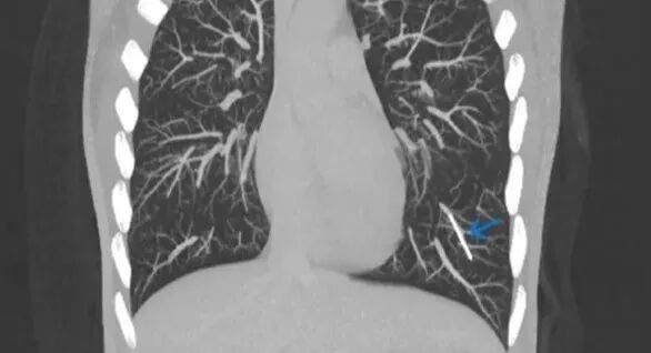 用于避孕的皮下埋植物通常很安全,但在罕见的情况下,它也有可能在人体内游走,甚至到达肺部。图中蓝色箭头标记的小棒就是进入肺部动脉的“流浪植入物”。 | Kareem et al.