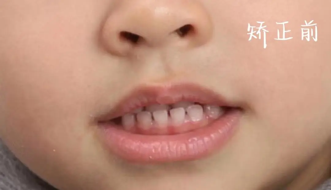 广州正畸许跃教授:发现地包天该怎么办?几岁矫正合适?_凤凰网区域_凤凰网