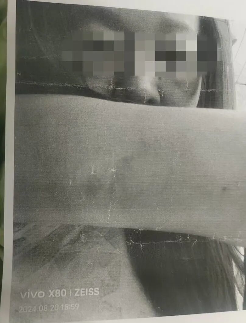 遭受殴打后的苗苗。图/受访者提供