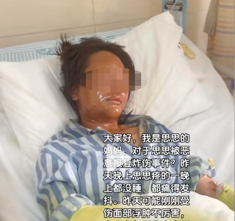 ▲思思面部和双手严重烧伤,敷满药物
